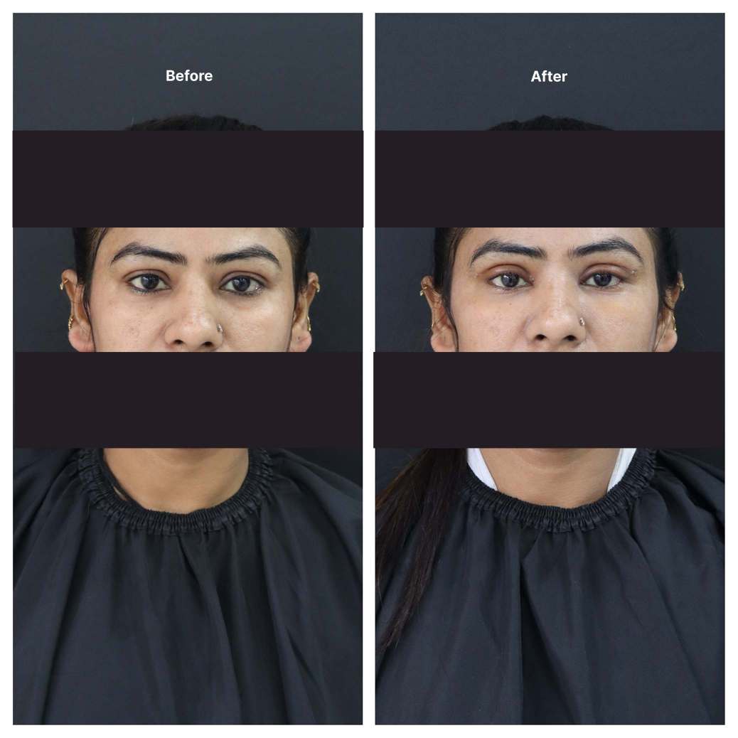 Eyelid Surgery KOQ10